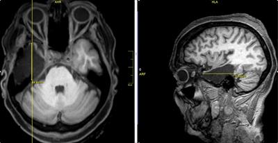 Long-Term Outcome of Temporal Lobe Epilepsy Surgery in 621 Patients With Hippocampal Sclerosis: Clinical and Surgical Prognostic Factors